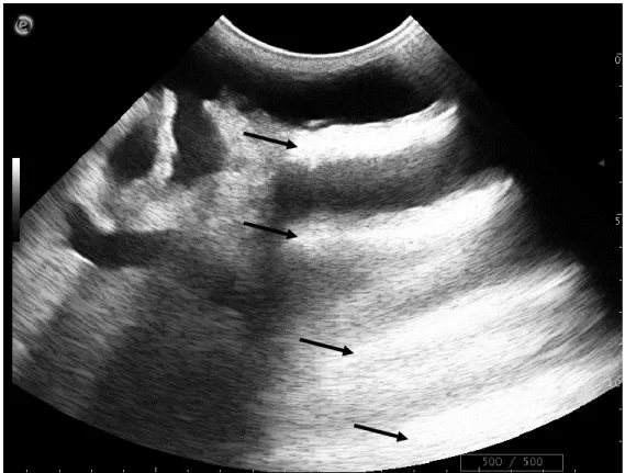 Figure 17 : Artefact de réverbération. Des lignes hyperéchogènes équidistantes et graduellement atténuées  apparaissent sous la paroi du trayon (flèches)