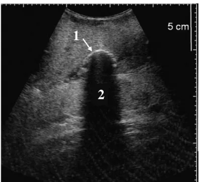 Figure  18  :  Cône  d’ombre.  Un  bout  de  bois  dans  une  mamelle  (1)  réfléchit  fortement  les  ultrasons :  il  apparait hyperéchogène et entraine un cône d’ombre (2)