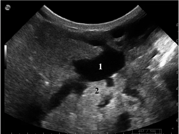 Figure 20 : Renforcement postérieur : le lait contenu dans la citerne glandulaire d’une mamelle (1) atténue  peu les ultrasons, l’aire située en-dessous est alors plus échogène, c’est le renforcement postérieur (2)