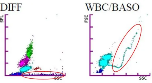 Figure 4 : Groupe C : extension du nuage des globules rouges non lysés vers la droite et  présence d’un “S” sur le diagramme “Baso”