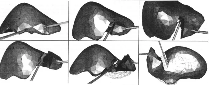 Figure 11 : Simulation de la laparoscopie du foie en utilisant le modèle «masse-tenseur »  en « grands déplacements » 
