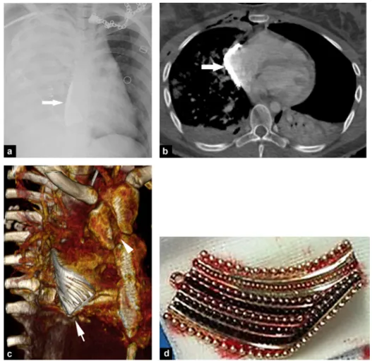Figure 1. A 20-year-old woman with thoracic injury following motorcycle accident. a: chest X-ray shows a «white right lung» aspect associated with a dense foreign body in contact with the right cardiac border (arrow); b: computed tomography (CT) image of t