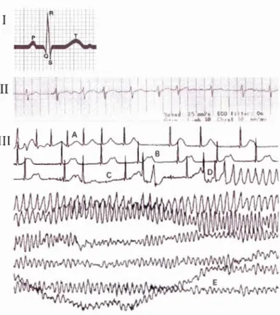 Figure 1.16  (I)  E l ec trocardio g ram  r e pr ese ntation  for  an  h ea lth y  p erso n  is  about 