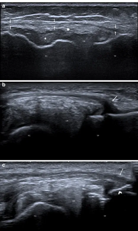 Fig. 2 Appearance of anterolateral ligament (ALL) on ultrasonography. Major axis of the anterolateral ligament of the knee; coronal plane image show ing the ligament in the major axis