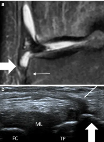 Fig. 3 Example of different findings on ultrasound and MRI. MRI coronal PD Fat Sat sequence (A) shows thickening at the anterolateral ligament (ALL)’s tibial insertion (thick arrow) without damage to the bone cortex at its enthesis, which is the site of gr