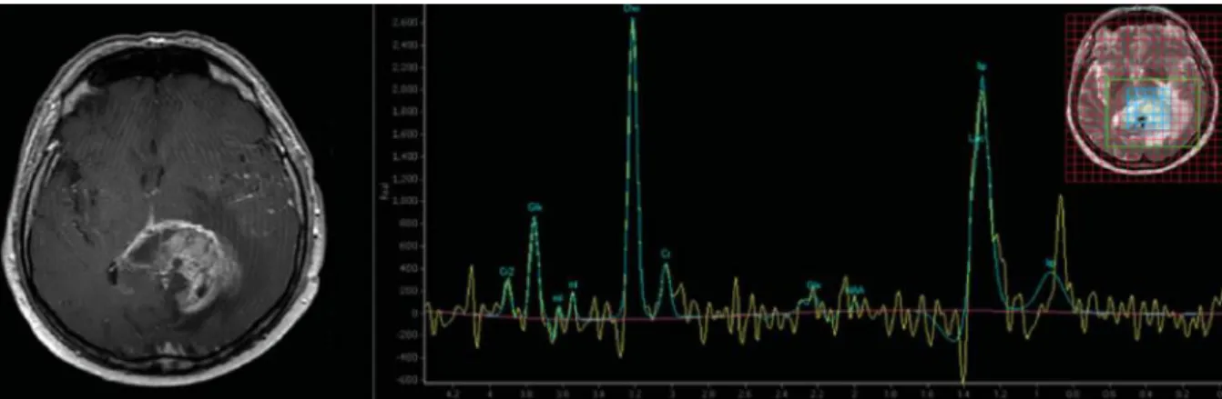 Figure 8 ISRM réalisée chez un patient atteint d'un GBM. On observe un rapport Cho/Cr &gt;2, un pic NAA diminué  et un pic en lactate dans la région d’intérêt (Young et al., 2015) 