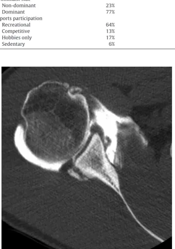 Fig. 3. Posteroinferior glenoid cartilage damage.