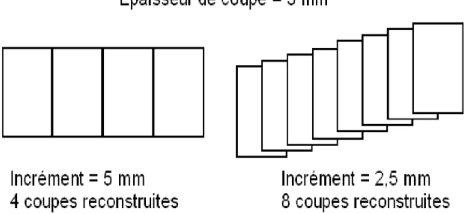 Figure 5 : Illustration de l’influence de l’incrément de reconstruction :   à gauche : coupes jointives ; à droite : coupes chevauchantes 