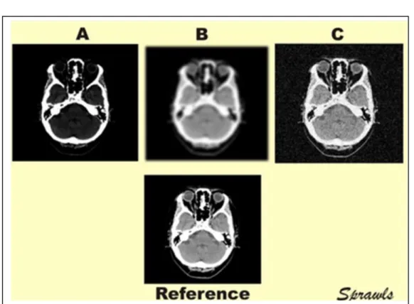 Figure 6 : Principaux facteurs influençant la qualité d’image ;   A : le contraste ; B : la résolution spatiale ; C : le bruit 