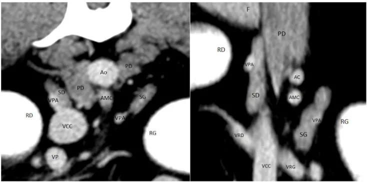 Figure 18 : Topographie tomodensitométrique des glandes surrénales gauche et droite en coupes  transverse (à gauche) et frontale (droite)  