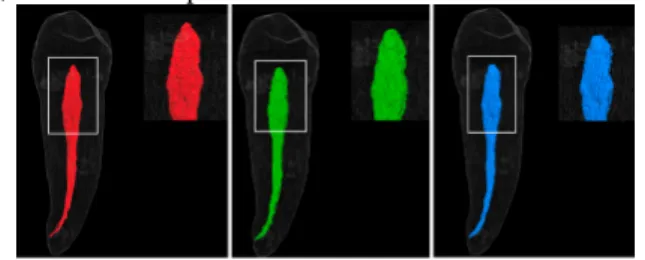 Fig. 1. Premolar root canal segmentation results from (a) high resolution µCT, (b) low resolution CBCT and (c) the estimated super-resolved CBCT data volumes.