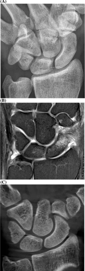 Fig. 1. Cortical scaphoid fracture in a 23-year-old man. a The initial coronal conventional ulnar deviation radiograph is normal