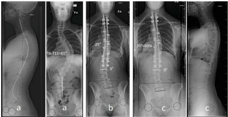 Fig. 2. Patient in the FDUV-5 ◦ group, Lenke 2A Adolescent Idiopathic Scoliosis, 14 years of age
