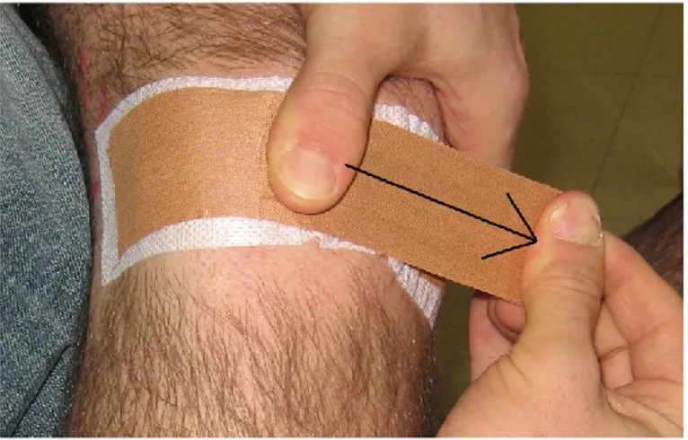 Figure 7 : Illustration of the tension manually  applied to the patellar taping 