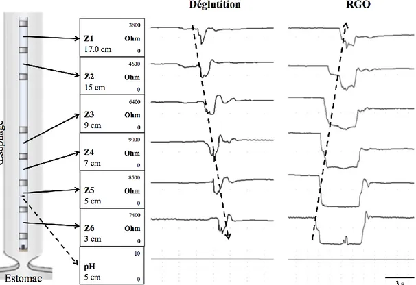 Figure 3. Représentation d’un reflux gastro-œsophagien liquide faiblement acide  comparativement à une déglutition (technique MII-pH) 