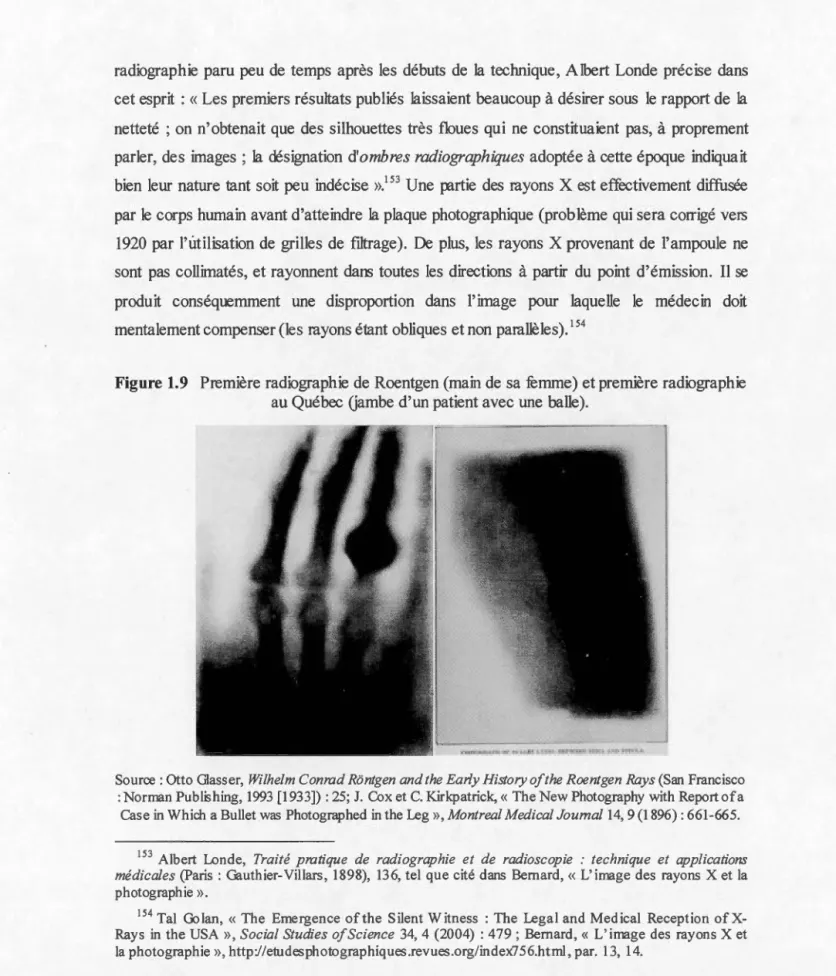 Figure  1.9  Première  radiographie  de Roentgen  (main de  sa femme)  et  première  radiographie  au Québec  Gambe  d' un  patient avec  une  balle)