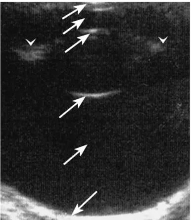 Figure	
  10	
  :	
  Echographie	
  d'un	
  oeil	
  normal	
  de	
  pur-­‐sang	
  	
  anglais	
  de	
  3	
  semaines.	
  Les	
  flèches	
  indiquent	
  du	
  haut	
   	
  
