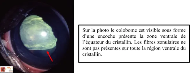 Figure	
  11	
  :	
  colobome	
  cristallinien	
  (flèche	
  rouge)	
  associé	
  à	
  une	
  cataracte	
  congénitale	
  chez	
  un	
  poulain