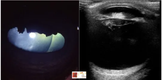 Figure	
  12	
  :	
  Aspect	
  clinique	
  (image	
  de	
  gauche)	
  et	
  échographique	
  (image	
  de	
  droite)	
  d’une	
  microphakie	
  chez	
   une	
  pouliche	
  pur-­‐sang	
  anglais
