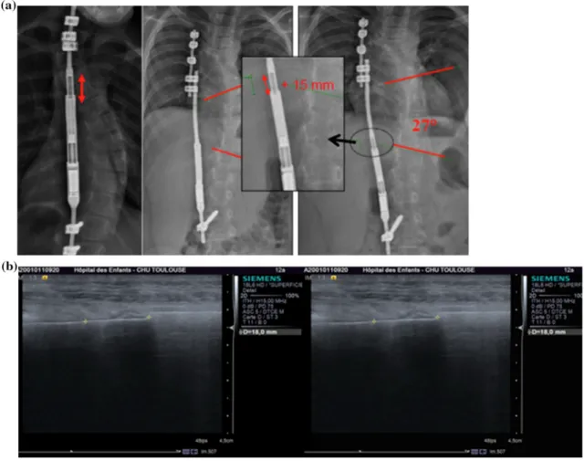 Fig. 1 Radiographic (a) and ultrasound (b) monitoring of the distraction before and after a distraction session