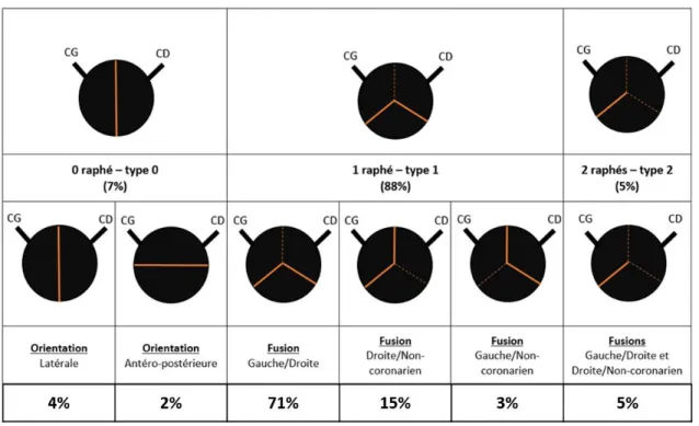 Tableau 1-1 : Classification et prévalence des différents sous-types de BAV selon Sievers &amp;  Schmidtke 