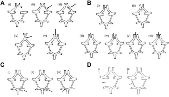 Figure 1.3 – Exemples d’anomalies de la configuration du cercle de Willis 