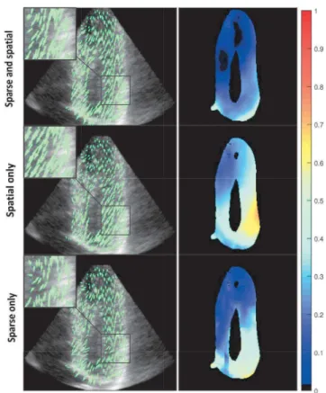 Fig. 1: The estimated flow fields (left) and the corresponding error maps (right) for the 20th frame of the LADprox sequence with separated and combined sparse and spatial regularizations.