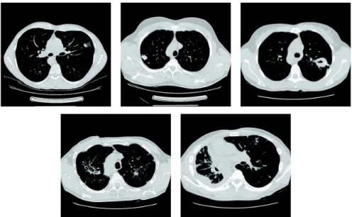 Fig. 2: Examples of the TB types. First row, from left to right: Infiltrative, Focal, and Tuberculoma types