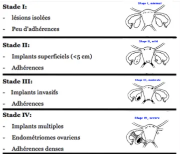 Figure 4 : Classification de l’endométriose 