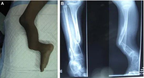 Fig. 14. A and B. Congenital pseudarthrosis. A complex situation in a humanitarian mission: what is the most suitable therapeutic indication?