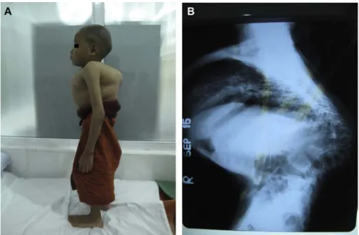 Fig. 2. Progressive Pott’s kyphosis in 8-year-old boy.