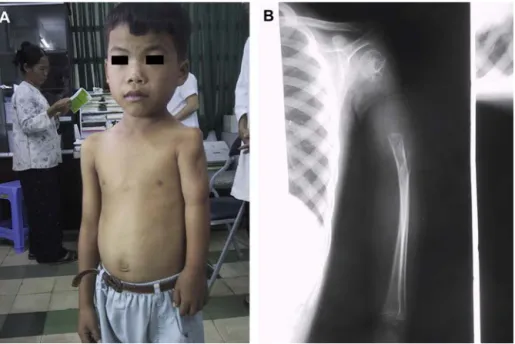 Fig. 6. Sequela of osteomyelitis with bone defect and growth disorder. A. Clinical aspect
