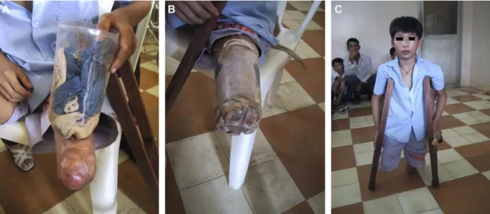 Fig. 8. Locally made low-cost and reasonably functional prosthesis.