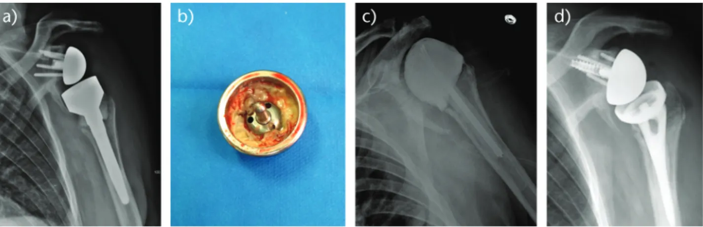 Fig. 2  Radiographs (a and b) of an 86-year-old woman, with a loose implant secondary to chronic periprosthetic shoulder infection