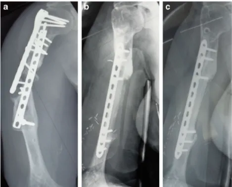 Fig. 1 Two successive failures of bone union by plating without bone addition (a). Removal of both plates; addition of vascularized fibula graft (b)