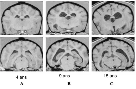 Figure 10 - Images  issues d’un examen d’Imagerie de R és onance Magnétique (IR M) d’un chien de 4 ans (A), d’un  chien de 9 ans  (B) et d’un chien de 15 ans (C) passant par le thalamus et l’hippocampe
