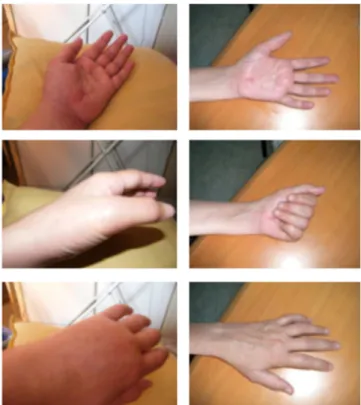Fig. 1. A 39-year-old female patient with type 1 complex regional painful syndrome (CRPS-1) who has signiﬁcant swelling in her hand before the PT-H sessions (left photos) and whose hand is normal after 5 sessions (right photos)