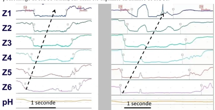 Figure  11 :  Exemples de reflux visualisés sur MMS Database (de gauche à droite) :  RGOs liquides, RGO mixte