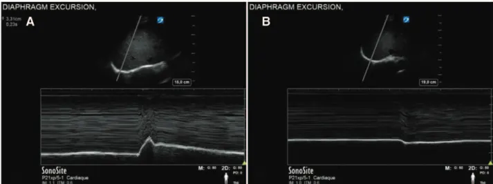 Figure 2. A, SSN leaving the superior trunk. The SSN was followed under ultrasound visualization into the subclavian triangle under the inferior  belly of the omohyoid muscle