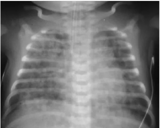 Figure 3. Radiographie d’un patient atteint d’un syndrome d’aspiration méconiale  (Tiré de Whitfield et al