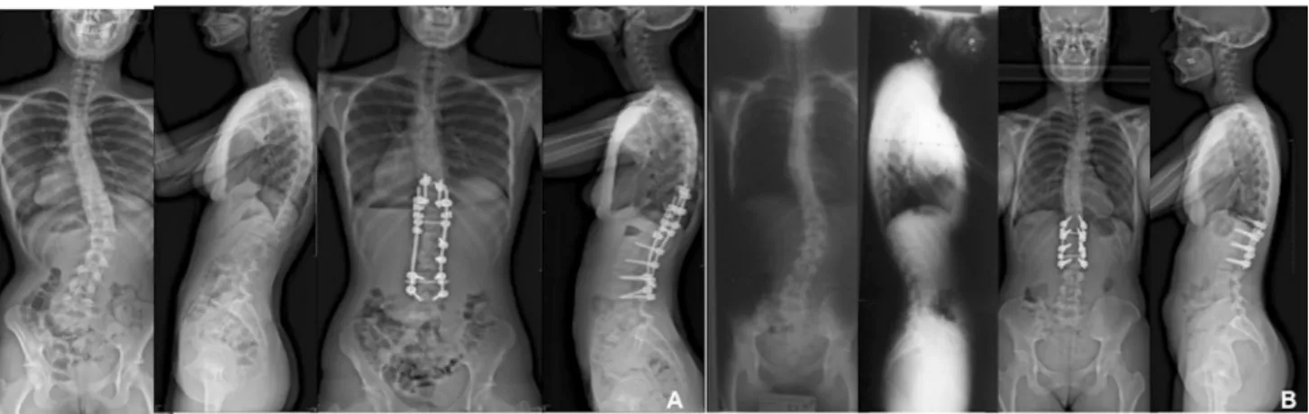 Fig. 1 Pre and postoperative X rays of patient of selective (a) and hyperselective group (b)