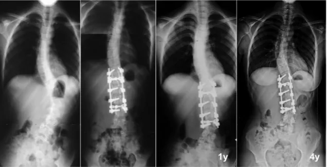 Fig. 3 Radiographic example of adding on phenomenon