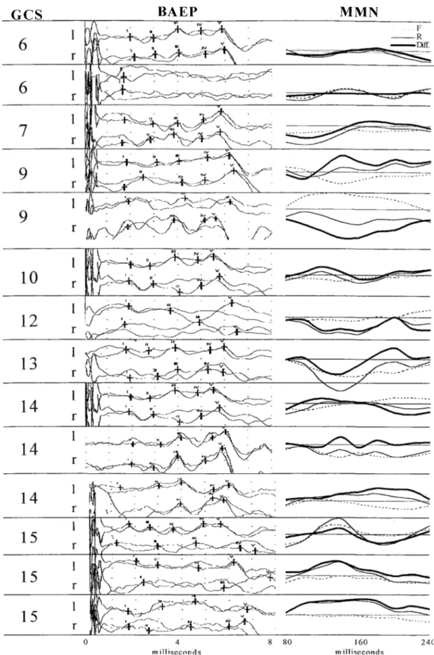 Fig. 1. Brainstem Auditory Ep (BAEP) and Mismatch Negativity (MMN) tracings of the 14 recordings (n=9)  according to their level of consciousness measured by the Glasgow Coma Scale (GCS)