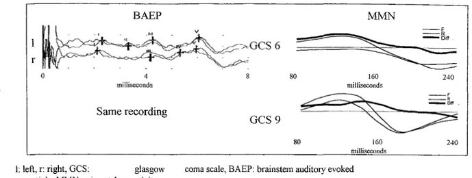 Figure 4 shows BAEP and MMN waveforms for this patient in coma and at emergence.  This case supports our previous data reporting that MMN can be recorded in coma and  particularly during emergence