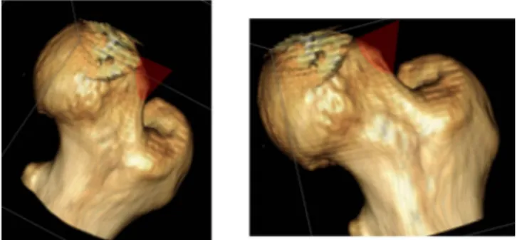 Fig. 2 Intra-operative fluoroscopic lateral view of the femoral  head and neck, before (left) and after (right) arthroscopic  osteoplasty.