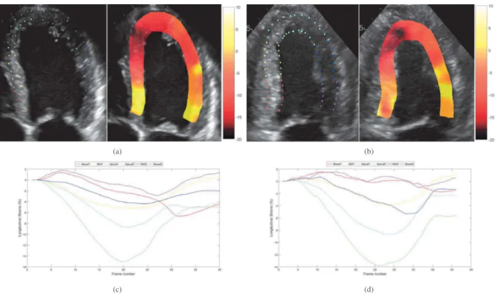 Fig. 2. In vivo longitudinal strain maps super-imposed to the B-mode images and strain curves over the cardiac cycle corresponding to the 6 myocardium segments
