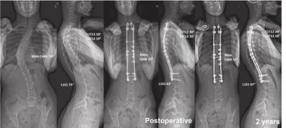 Fig. 4 Preoperative, postoperative and latest anteroposterior and lateral radiographs of a Lenke 1 AIS patient, showing a 4° spontaneous increase in T4T12 kyphosis during follow-up