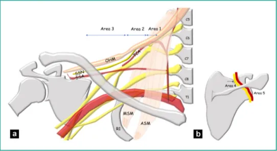 Figure 1. a: topography of the SSN in the suprascapular region. Area 1: origin of SSN on the superior trunk of the BP in the interscalene triangle delimited anteriorly by the ASM and posteriorly by the MSM