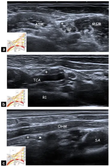 Figure 2. Ultrasonography of the cervical portion of the SSN; a: area 1: axial ultrasonography view showing the SSN (star) where it arises from the BP at the level of the interscalene triangle between ASM and MSM; b: area 2: axial ultrasonography view show