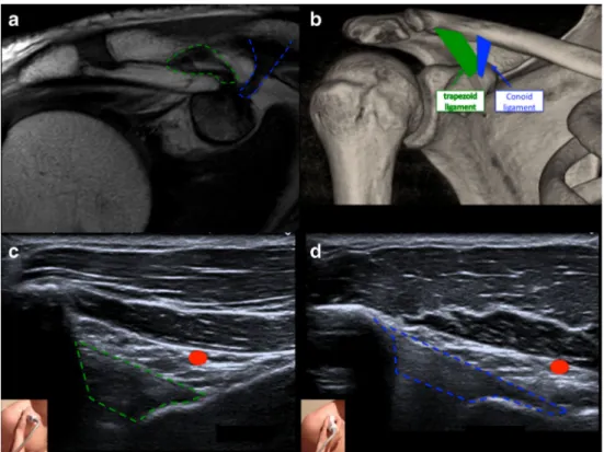 Fig. 1 The coracoclavicular ligaments. a)MRI T1 coronal view showing the